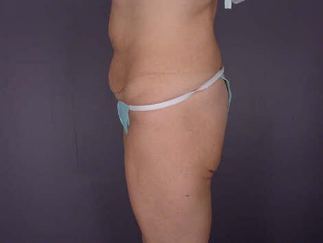 Tummy Tuck Before & After Image