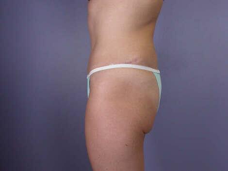 Tummy Tuck Before & After Image