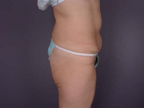 Tummy Tuck Before & After Image