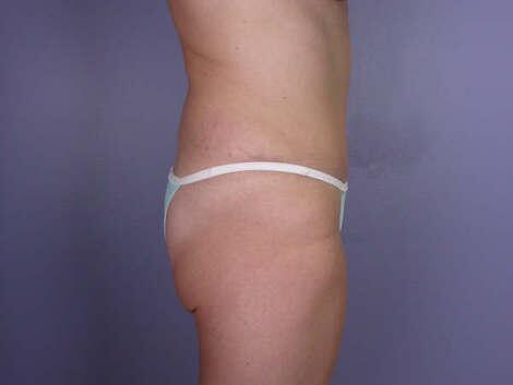 Tummy Tuck Before & After Image