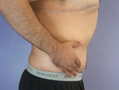 Tummy Tuck Before & After Image