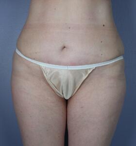 Tummy Tuck Before & After Image