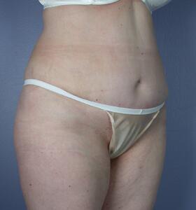 Tummy Tuck Before & After Image