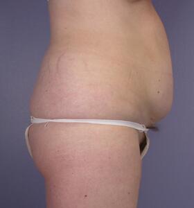 Tummy Tuck Before & After Image