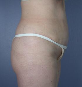 Tummy Tuck Before & After Image