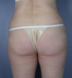 Tummy Tuck Before & After Image