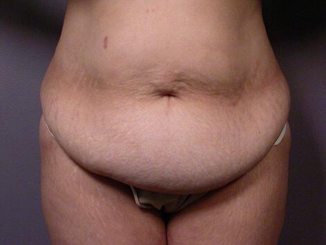 Tummy Tuck Before & After Image