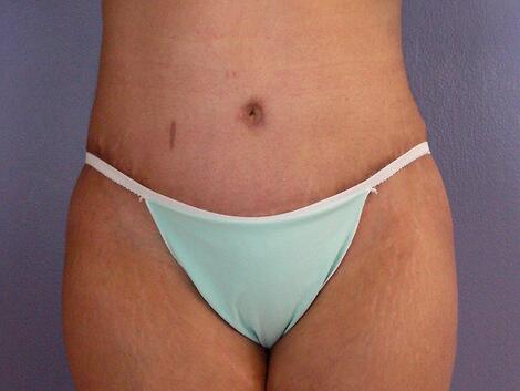 Tummy Tuck Before & After Image