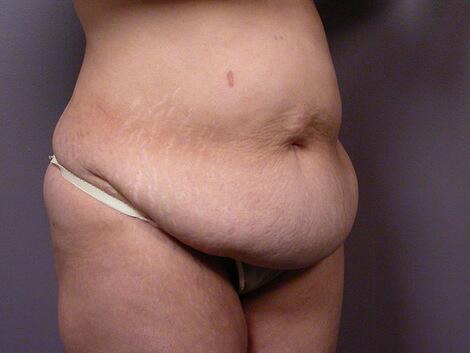 Tummy Tuck Before & After Image