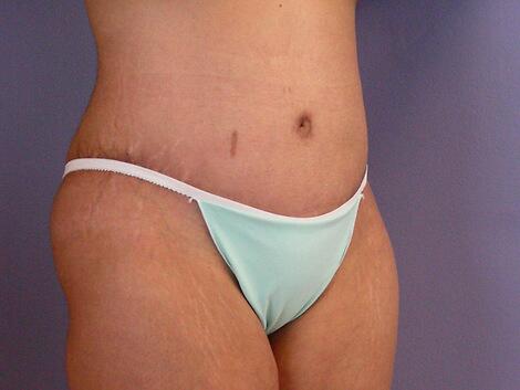 Tummy Tuck Before & After Image