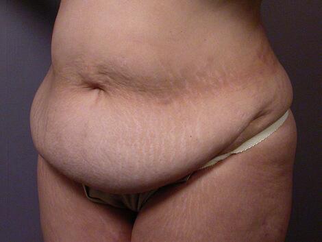 Tummy Tuck Before & After Image