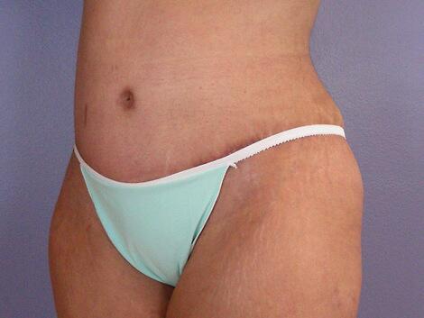 Tummy Tuck Before & After Image