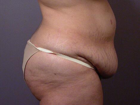 Tummy Tuck Before & After Image