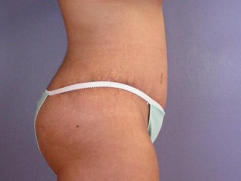 Tummy Tuck Before & After Image