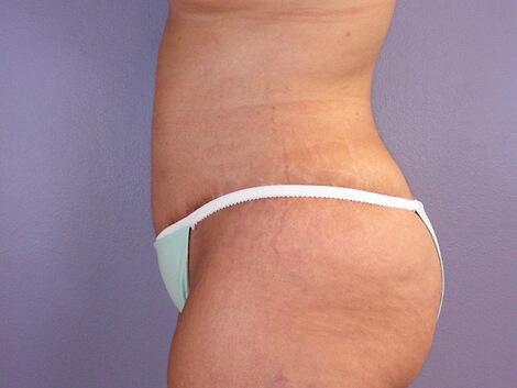 Tummy Tuck Before & After Image