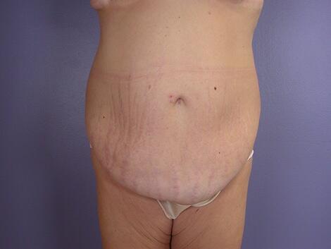 Tummy Tuck Before & After Image