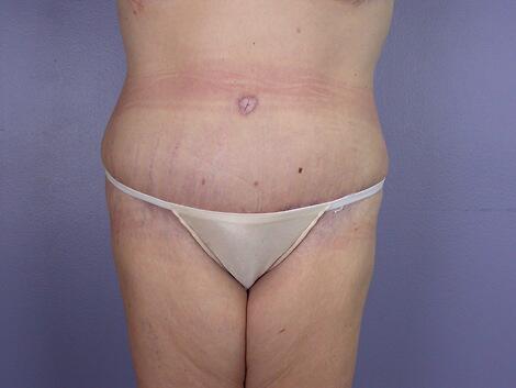 Tummy Tuck Before & After Image