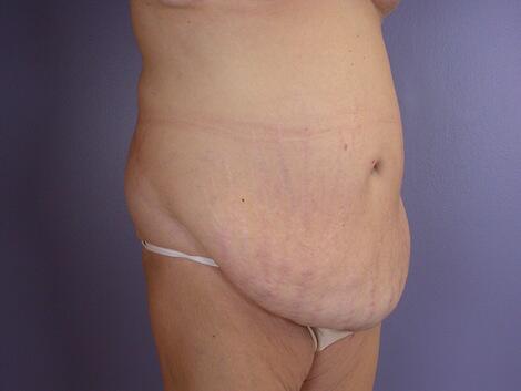 Tummy Tuck Before & After Image