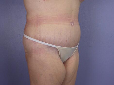 Tummy Tuck Before & After Image