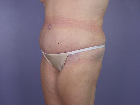 Tummy Tuck Before & After Image