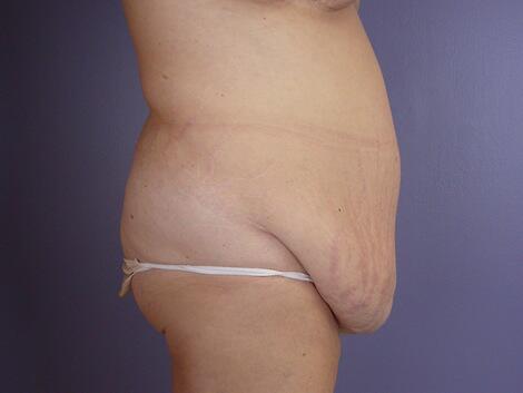 Tummy Tuck Before & After Image