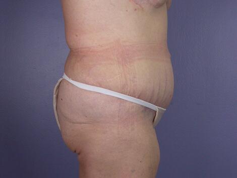 Tummy Tuck Before & After Image