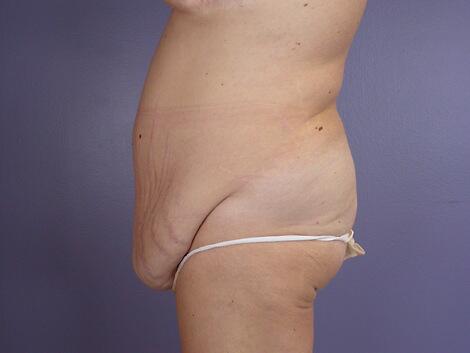 Tummy Tuck Before & After Image