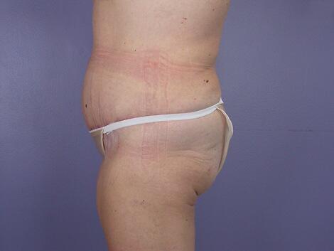 Tummy Tuck Before & After Image