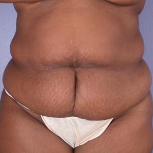 Tummy Tuck Before & After Image