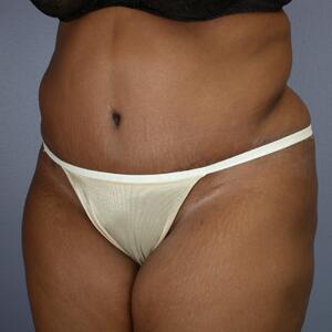 Tummy Tuck Before & After Image