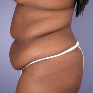 Tummy Tuck Before & After Image