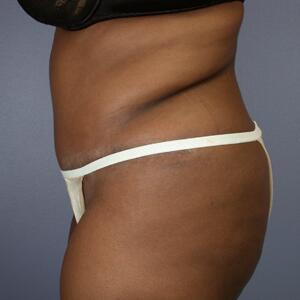 Tummy Tuck Before & After Image