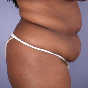 Tummy Tuck Before & After Image