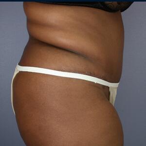 Tummy Tuck Before & After Image