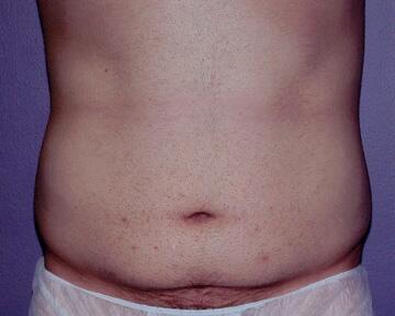 Tummy Tuck Before & After Image