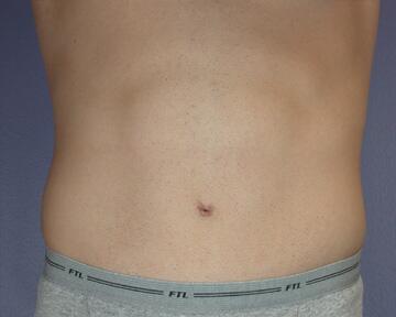 Tummy Tuck Before & After Image