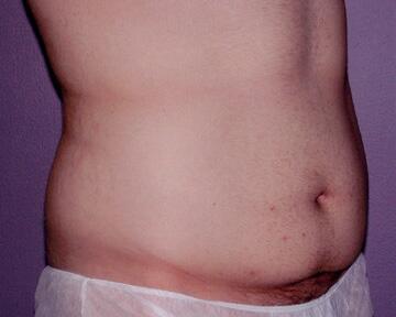 Tummy Tuck Before & After Image