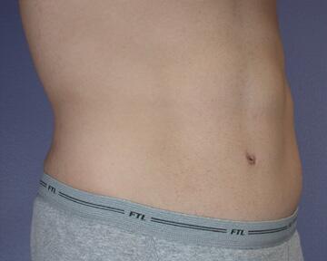 Tummy Tuck Before & After Image