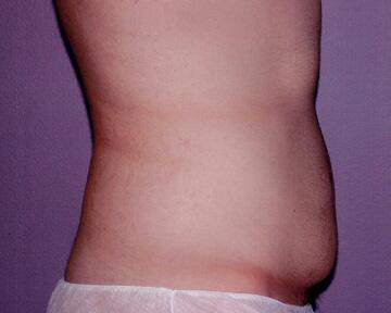 Tummy Tuck Before & After Image