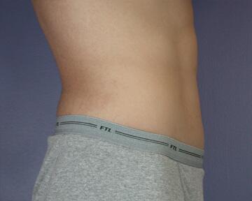 Tummy Tuck Before & After Image