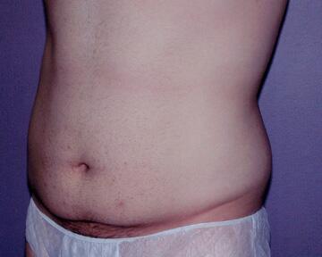 Tummy Tuck Before & After Image