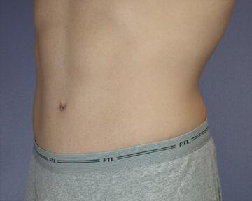 Tummy Tuck Before & After Image