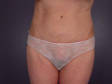 Tummy Tuck Before & After Image