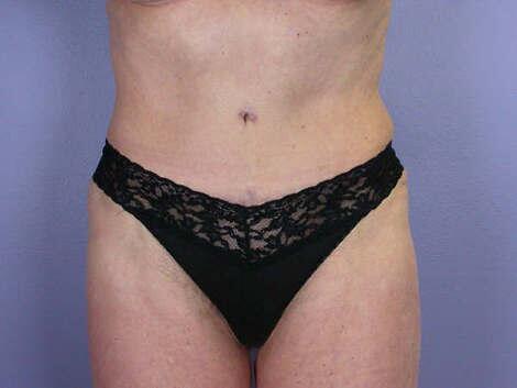 Tummy Tuck Before & After Image