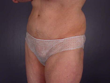 Tummy Tuck Before & After Image