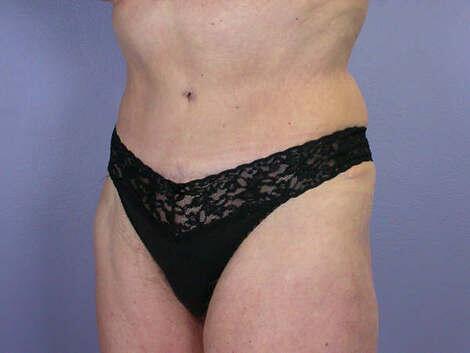 Tummy Tuck Before & After Image