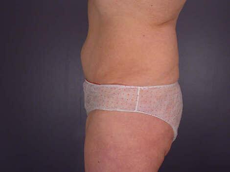 Tummy Tuck Before & After Image