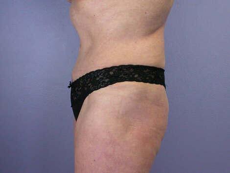 Tummy Tuck Before & After Image