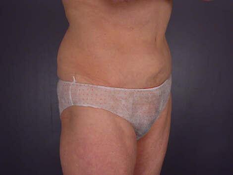 Tummy Tuck Before & After Image