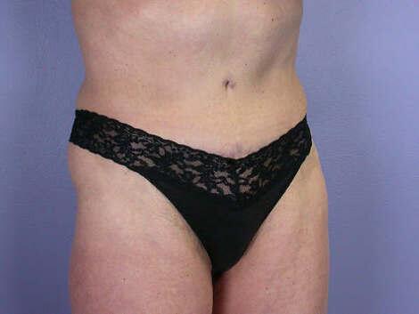 Tummy Tuck Before & After Image